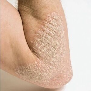 Body Foam against Psoriasis